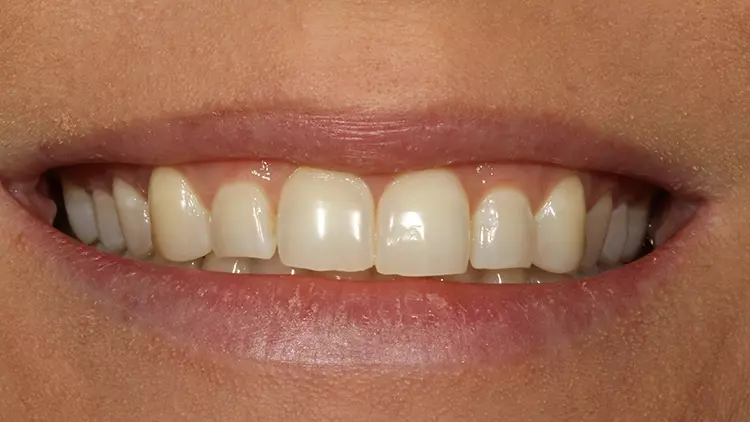 Abb. 25: Lippenbild der Zähne einer Patientin mit erosiv-abrasiven Komponenten.