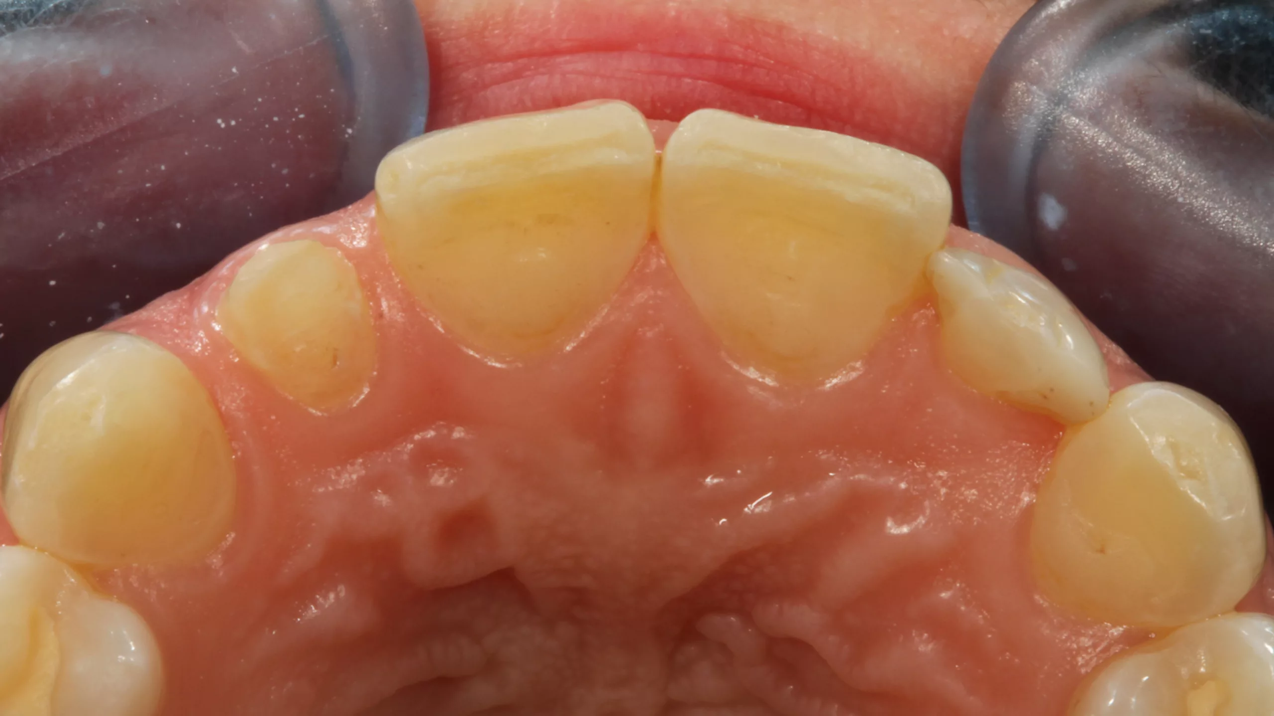 Abb. 12: Beide seitlichen Schneidezähne sind sehr kleine Zapfenzähne, deren ästhetische Verbreiterung vor einigen Jahren in direkter Technik vorgenommen worden war.