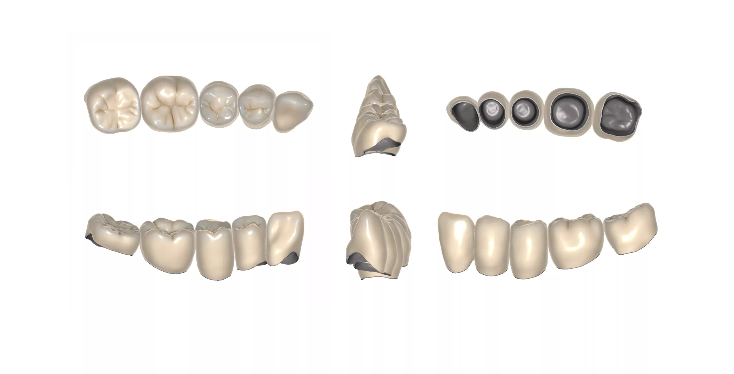 Abb. 28: CAD-Konstruktion von 5 Seitenzahnkronen mittels der Dental-CAD-Software Modellier (Zirkonzahn) in den verschiedenen Ansichten.