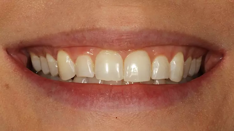 Abb. 29: Lippenbild nach Aufbau der Zähne 13 und 23.