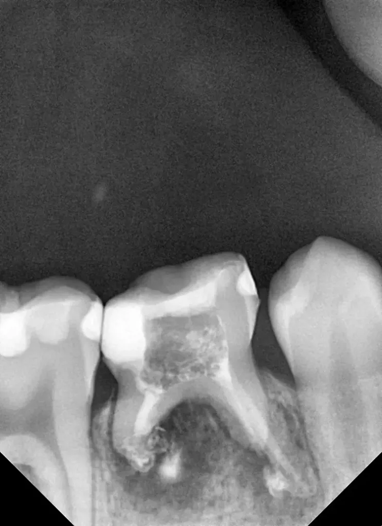 Kalziumhydroxidpräparat unter dem adhäsiven Verschluss.