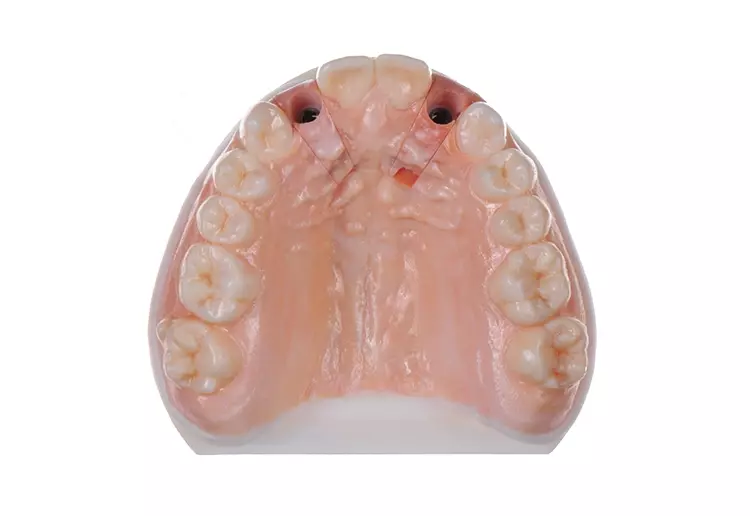 Abb. 2: Mithilfe von Multimaterial-3D-Druck (Stratasys) gebautes Vollfarben-
3D-Implantatmodell.
