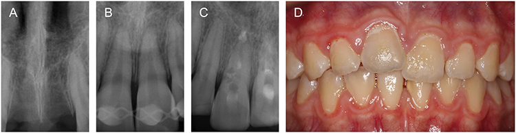 Abb. 2: Schwere Parodontalschäden, wie sie bei langer Trockenlagerung nach Avulsionen zu erwarten sind, können zu Ersatzresorptionen führen. (A) Avulsion der
Zähne 11 und 21. (B) Replantation und Schienung. (C) Allgemeine Resorption der Zahnwurzeln nach 3 Jahren. Eine Ankylose kann zur Wachstumshemmung des
Alveolarfortsatzes und zu einer Infraposition der betroffenen Zähne führen. (D) Der ehemals avulsierte Zahn 11 befindet sich 4 Jahre nach dem Trauma deutlich in
Infraposition.