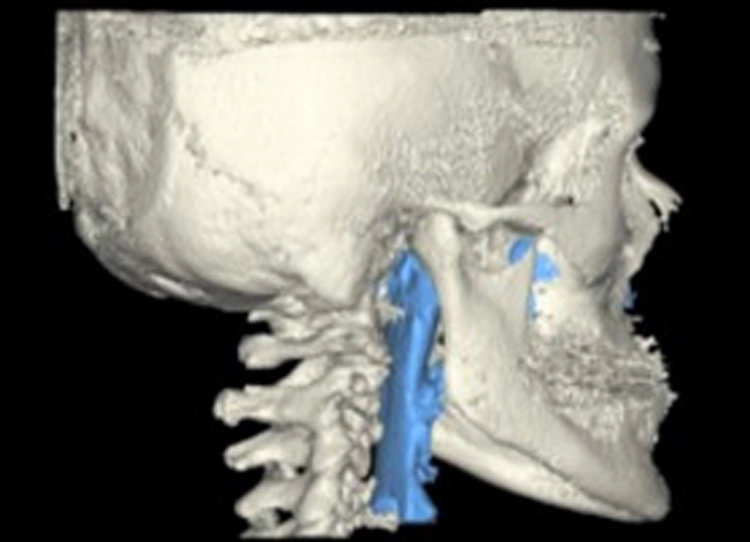 Abb. 2: 3D-Darstellung des Posterior Airway Space PAS, basierend auf unserem DVT-Datensatz (Gromeik [8]).