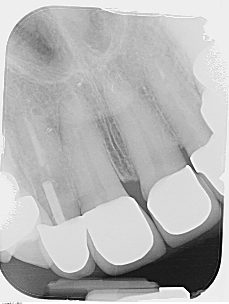 Abb. 2: Zahnfilm von 12. Endodontischer Misserfolg mit dislozierter Stiftversorgung und tiefer komplizierter Fraktur.