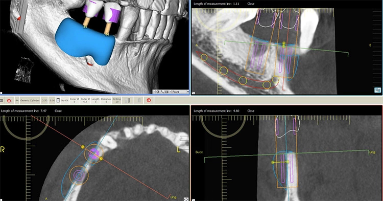 Abb. 2: Digitales backward-planning: die ideale Implantatposition gibt das nötige Augmentatvolumen wider, anhand dessen der allogene Knochenblock geplant und gefräst wurde.