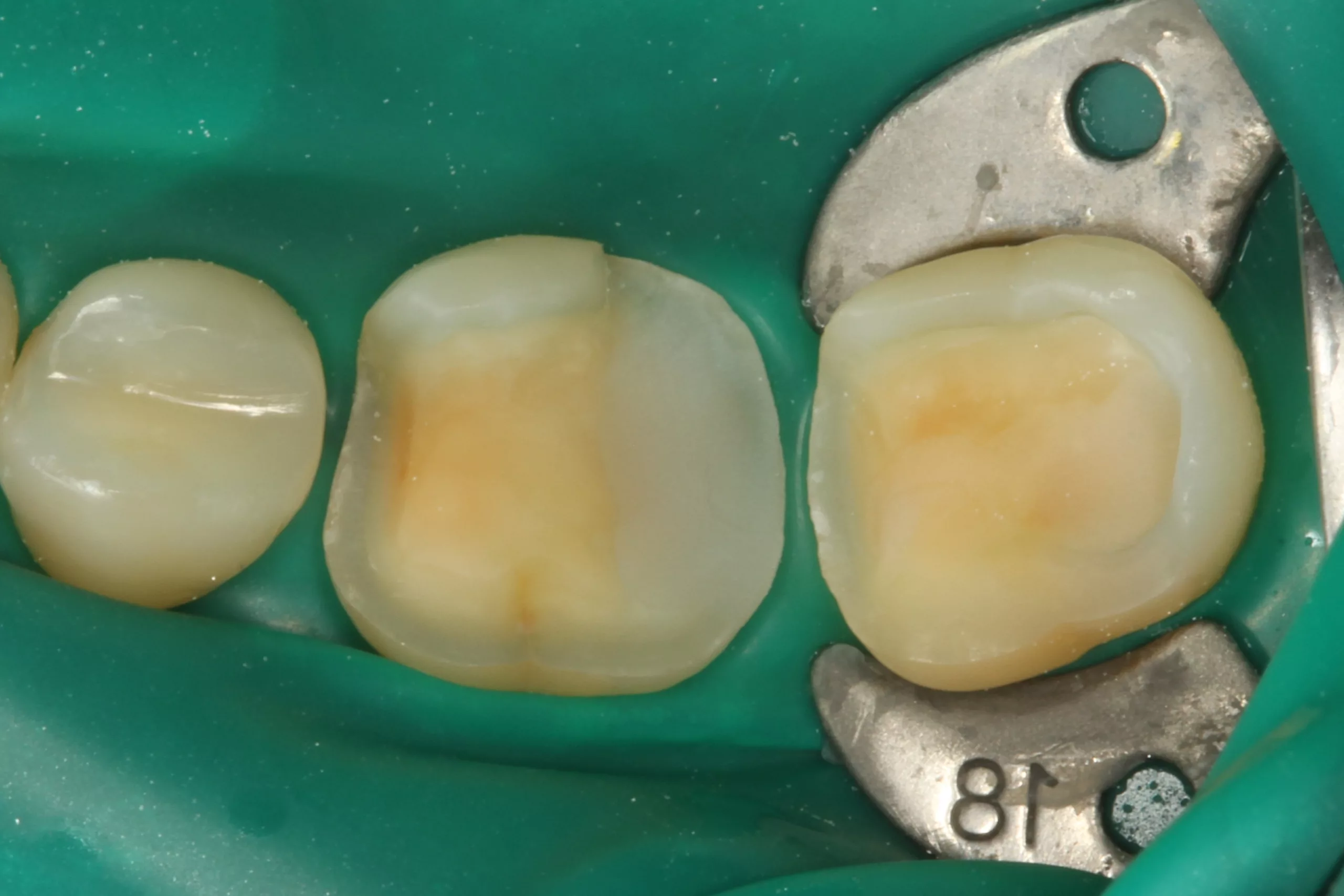 Abb. 2: Der isolierte Arbeitsbereich nach dem Abstrahlen der Kompositfläche an Zahn 46 mit 50 ?m Aluminiumoxid.