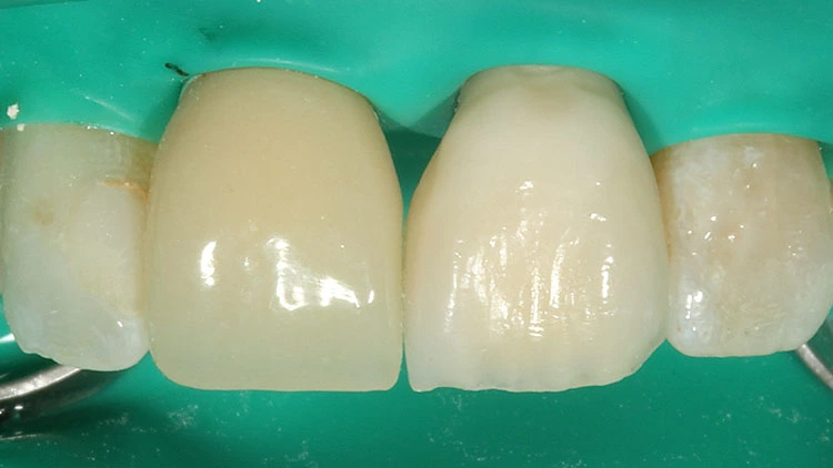 Abb. 2: Der mit CoJet abgestrahlte basale Anteil der Implantatkrone 21.