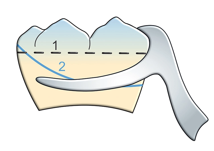 Abb. 2: Modellgussklammer von bukkal. Der Klammerunterarm reicht in den untersichgehenden Bereich. 1 = anatomischer Äquator, 2 = prothetischer Äquator.