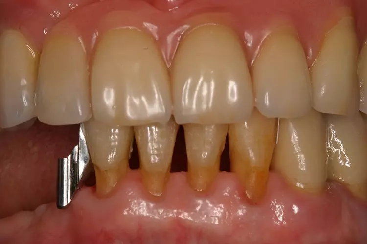 Abb. 2: Adhäsivattachment am karies- und restaurationsfreien Zahn 42 zur
Reparatur der vorhandenen Geschiebearbeit (Frontalansicht).