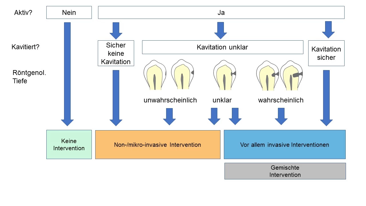 Abb. 2: Therapieentscheid für Approximalkariesläsionen. Aktivität und Kavitation sind die Schlüsselfaktoren zur Auswahl der richtigen Interventionsschwelle. Da die visuell-taktile Beurteilung nur bedingt zuverlässige Hinweise auf die Wahrscheinlichkeit einer Kavitation der Läsion gibt, wird die röntgenologische Ausdehnung zur Abschätzung der Kavitationswahrscheinlichkeit eingesetzt. Für schmelzbegrenzte Läsionen (E1/E2) ist eine Kavitation unwahrscheinlich. Läsionen mit einer Ausdehnung bis zum äußeren Dentindrittel (D1) sind mit größerer Wahrscheinlichkeit nicht kavitiert. Bei Ausdehnung bis in das mittlere oder innere Dentindrittel (D2/D3) kann von 
einer Kavitation ausgegangen werden [2]. Mit der Evaluation verschiedener Risikofaktoren kann das individuelle Kariesrisiko des Patienten bestimmt werden und in der Entscheidungsfindung für nichtinvasive oder mikroinvasive Maßnahmen berücksichtigt werden [1,32].
