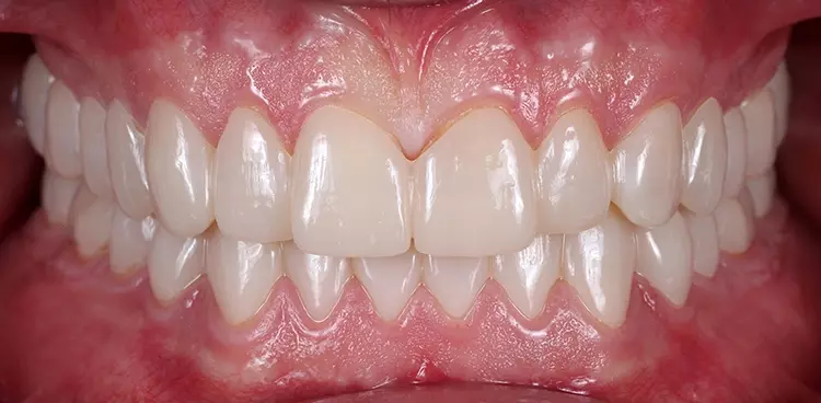 Abb. 2: Herausnehmbare Okklusionsschienen nach der Eingliederung zur
funktionellen und ästhetischen Evaluation der im Wax-up festgelegten neuen
Bisslage.