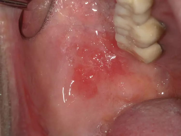 Abb. 2: Erythroplakie der Wange.