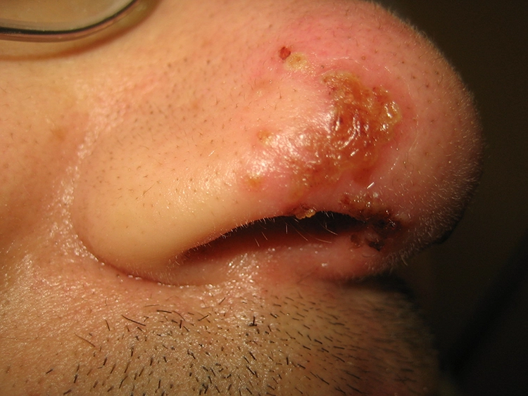 Abb. 2: Herpes simplex mit Lokalisation an der Gaumenschleimhaut. In beiden Fällen wurde HSV in hoher Kopienzahl im Mundspülwasser nachgewiesen.