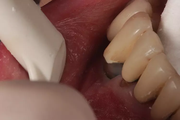 Abb. 2: Endodontische Versorgung des Zahnes 43 nach vorangegangenen rezidivierenden
parodontalen Beschwerden.