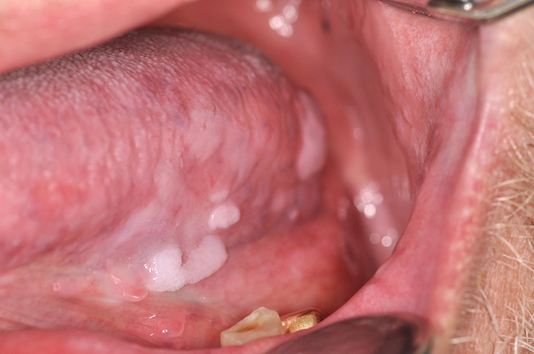 Mäßiggradig, SIN 2: Mäßig- bis hochgradige Leukoplakien zeigen sich unregelmäßig, knötchenförmig oder verrukös sowie vorwiegend weiß beziehungsweise als weiß-rote Erythroleukoplakien [3].