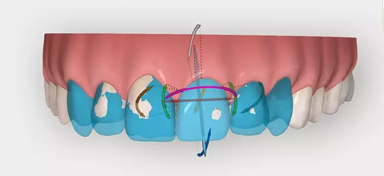 Abb. 2: Die neue Invisalign Smile Architect Software erleichtert die Planung einer restaurativen Behandlungsstrecke mit kieferorthopädischer Korrektur.