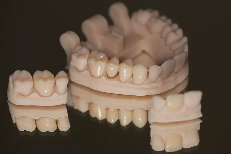 Modell aus V-Print 2.0 mit provisorischer Versorgung aus dem neuen V-Print c&b temp.