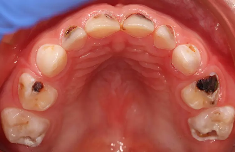 Abb. 2a-c: Zähne beim 2. Besuch vor der Applikation von Riva Star®, SDI Dental Limited. Die Mundhygiene hatte sich im Vergleich zum Erstbesuch bereits erheblich verbessert. Zudem wiesen einige Läsionen bereits erste Anzeichen der Kariesinaktivierung auf. Viele Dentinläsionen waren aber weiterhin gelb-braun und weich bei Sondierung.(b) im Oberkiefer.