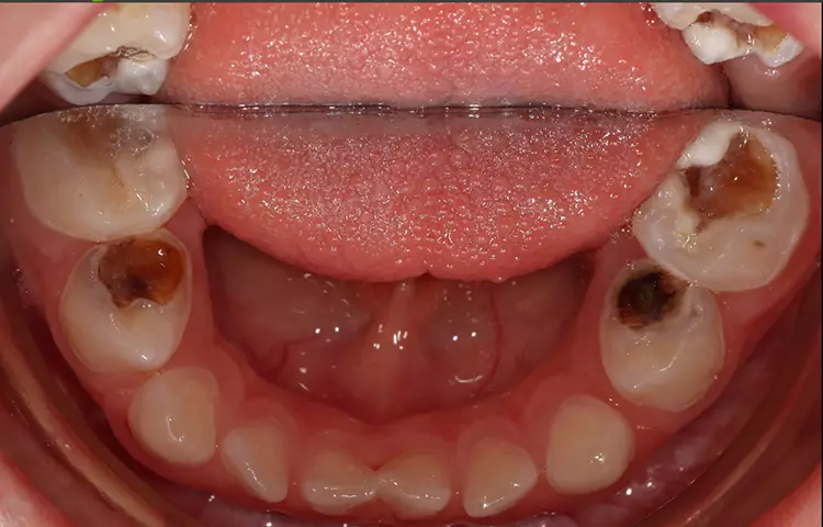 Abb. 2a-c: Zähne beim 2. Besuch vor der Applikation von Riva Star®, SDI Dental Limited. Die Mundhygiene hatte sich im Vergleich zum Erstbesuch bereits erheblich verbessert. Zudem wiesen einige Läsionen bereits erste Anzeichen der Kariesinaktivierung auf. Viele Dentinläsionen waren aber weiterhin gelb-braun und weich bei Sondierung. (c) im Unterkiefer.