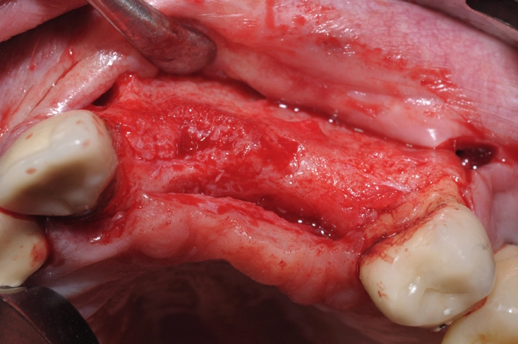 Abb. 2: Darstellung des vorliegenden Knochendefekts.