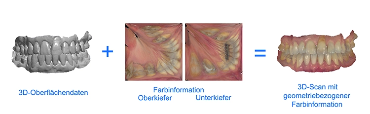 Abb. 2: Die Oberflächendaten aus den intraoralen 3D-Scans der Kiefer ergeben zusammen mit den Farbinformationen 3D-Scans mit geometriebezogener Farbinformation.