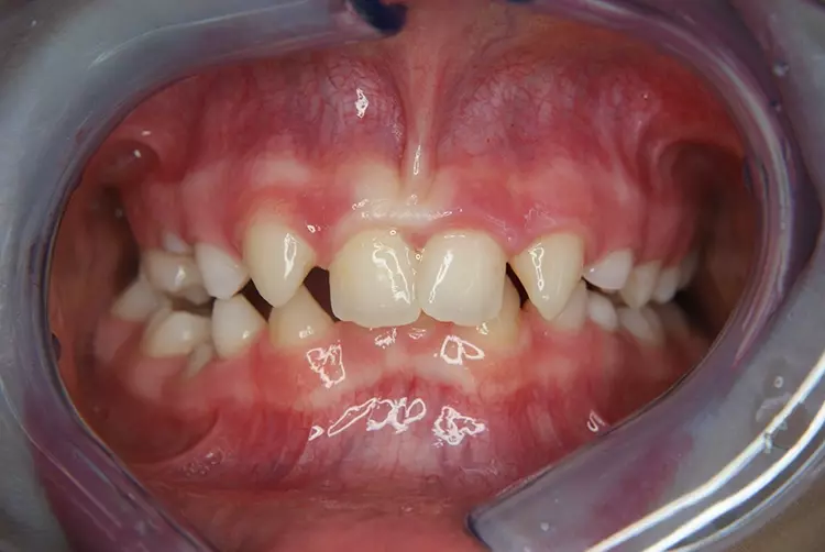 Abb. 2a: 13-jährige Patientin mit multipler Nichtanlage 2011.
