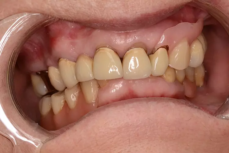 Abb. 2a: Ausgangssituation mit Interimsprothese.