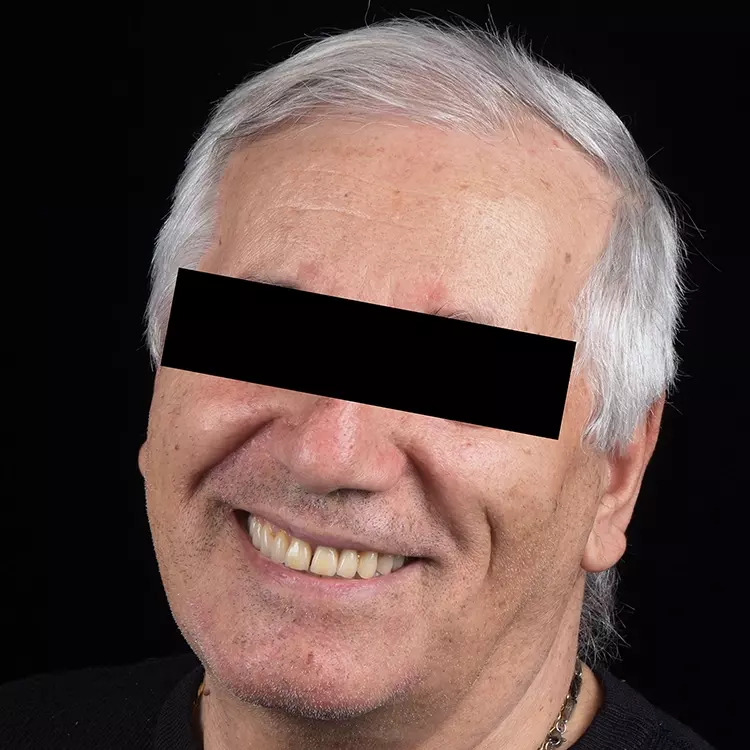 Endergebnis: Das definitive totalprothetische Ergebnis fügte sich harmonisch in das Gesamtbild ein.