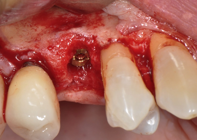 Abb. 10: Auffüllen des Spalts nach vestibulär mit Knochenspänen.