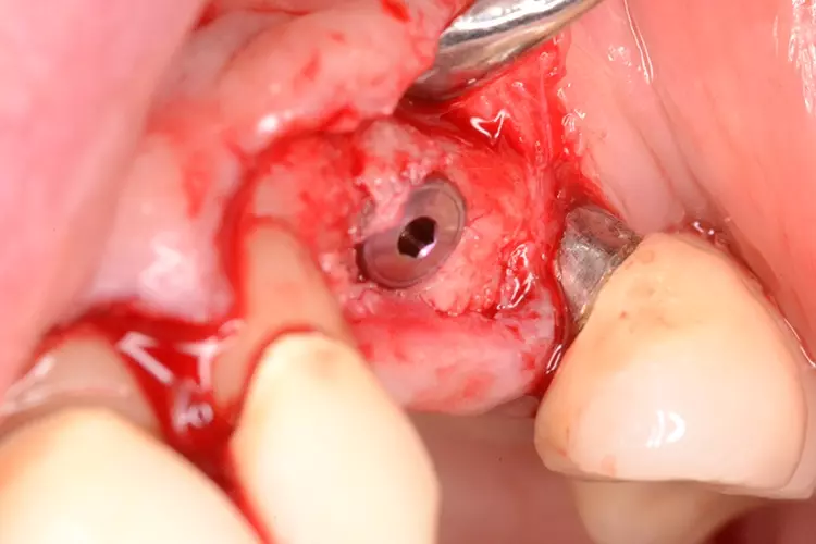 Abb. 2c: Implantat regio 23.
