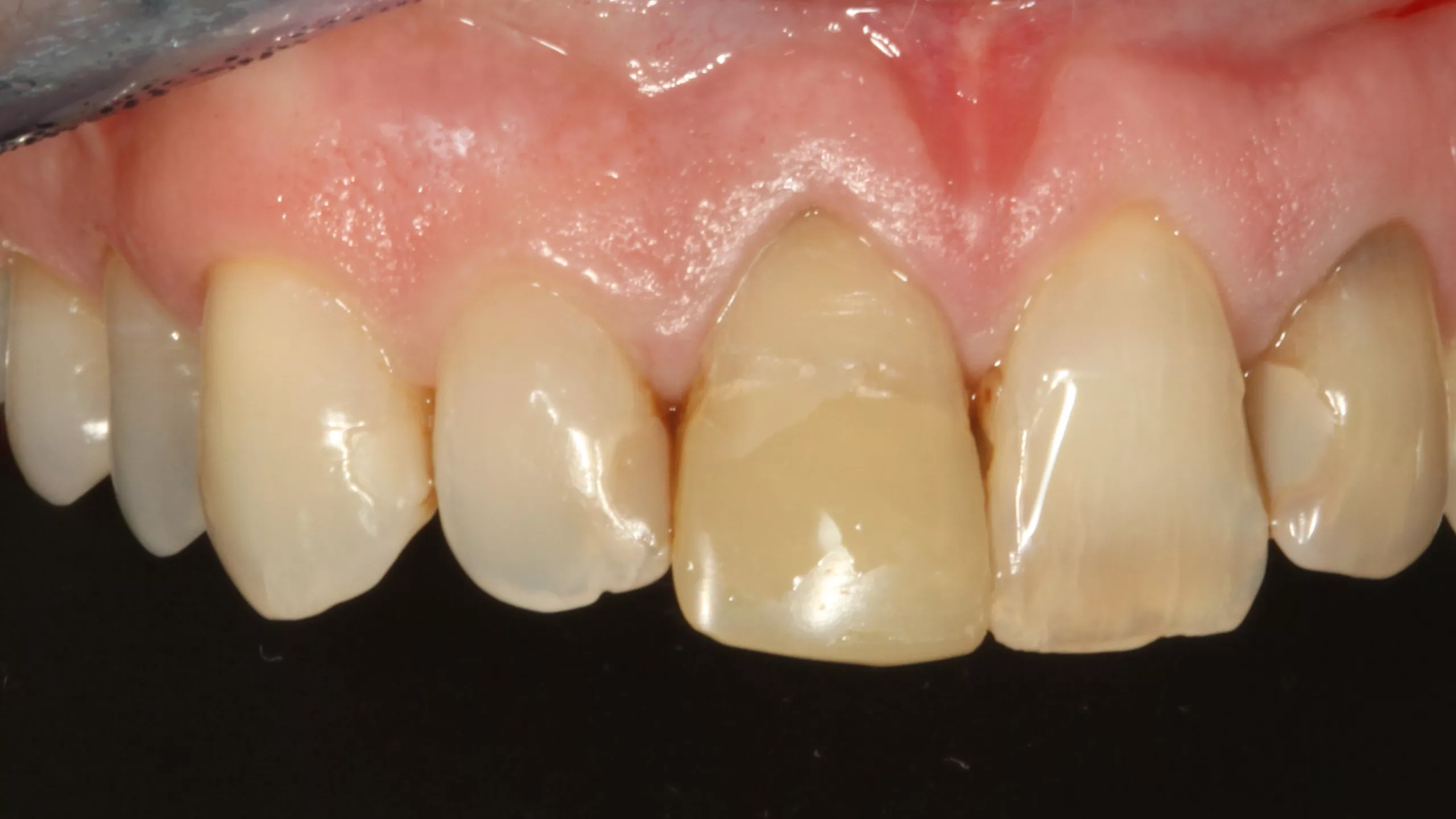 Abb. 30: Detailansicht der Frontzähne aus rechts-lateralem Blickwinkel.