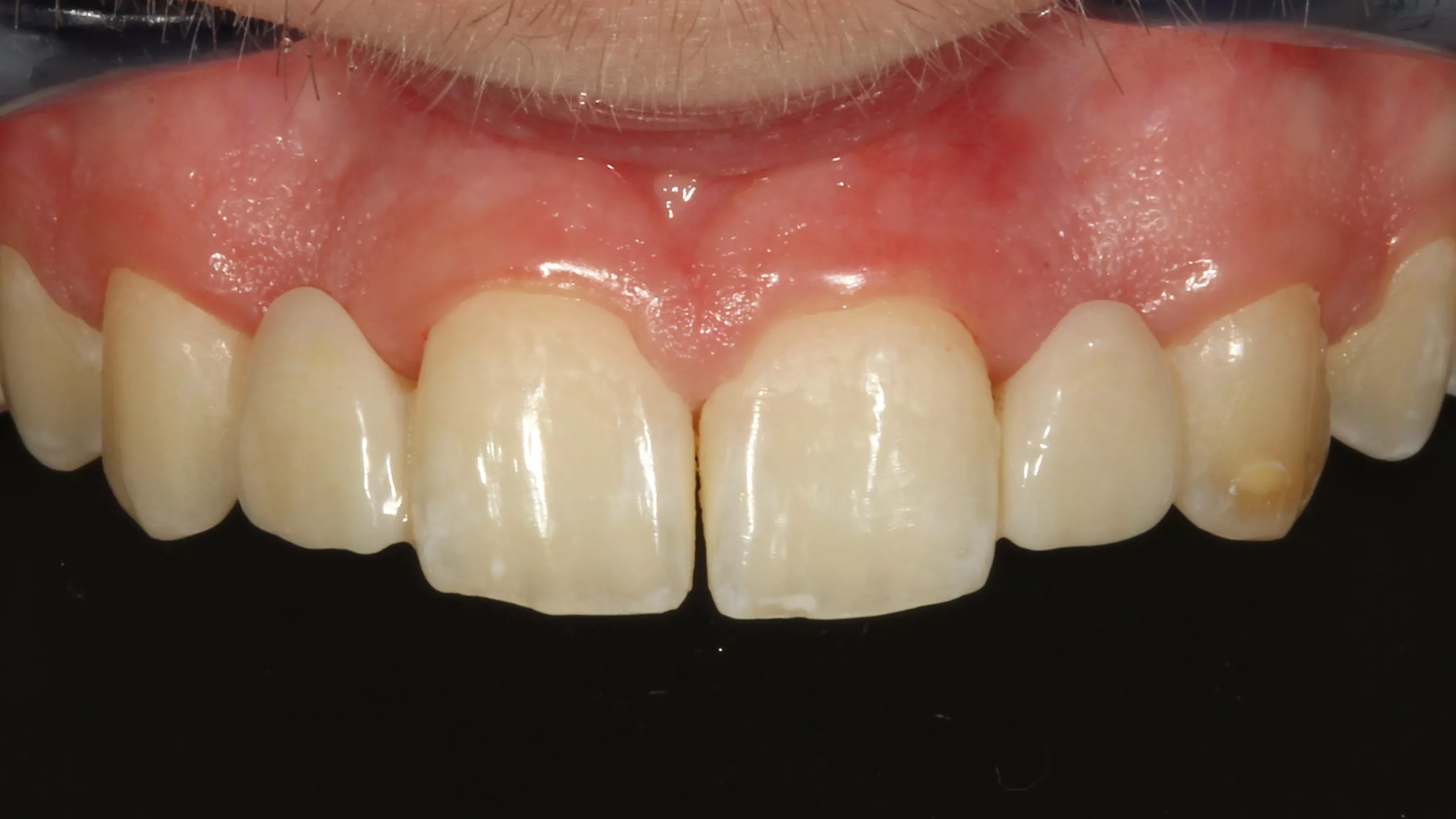 Abb. 51: En-face-Ansicht der Versorgung mit adhäsiven, einflügeligen Klebebrücken zum Ersatz der beiden seitlichen Schneidezähne.