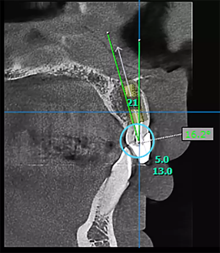 Abb. 2d: Röntgenologische Implantat-Planung.