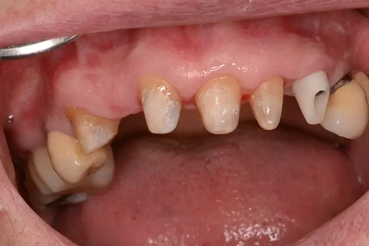 Abb. 2g: Zirkonabutment.