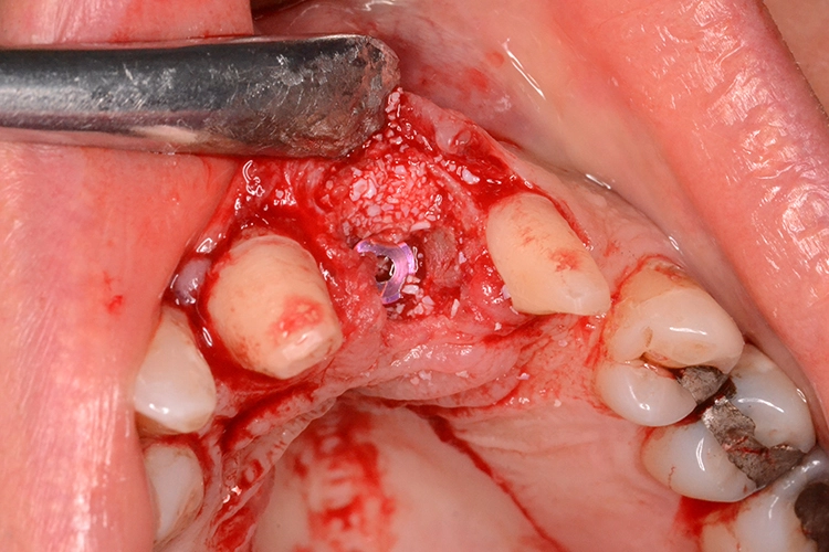 Abb. 2h: Augmentation.