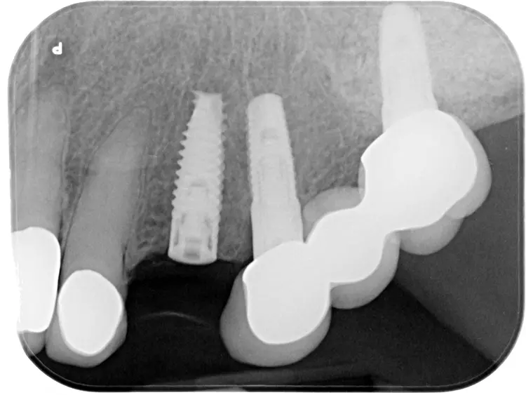 Abb. 2i: Röntgenkontrolle Implantat.