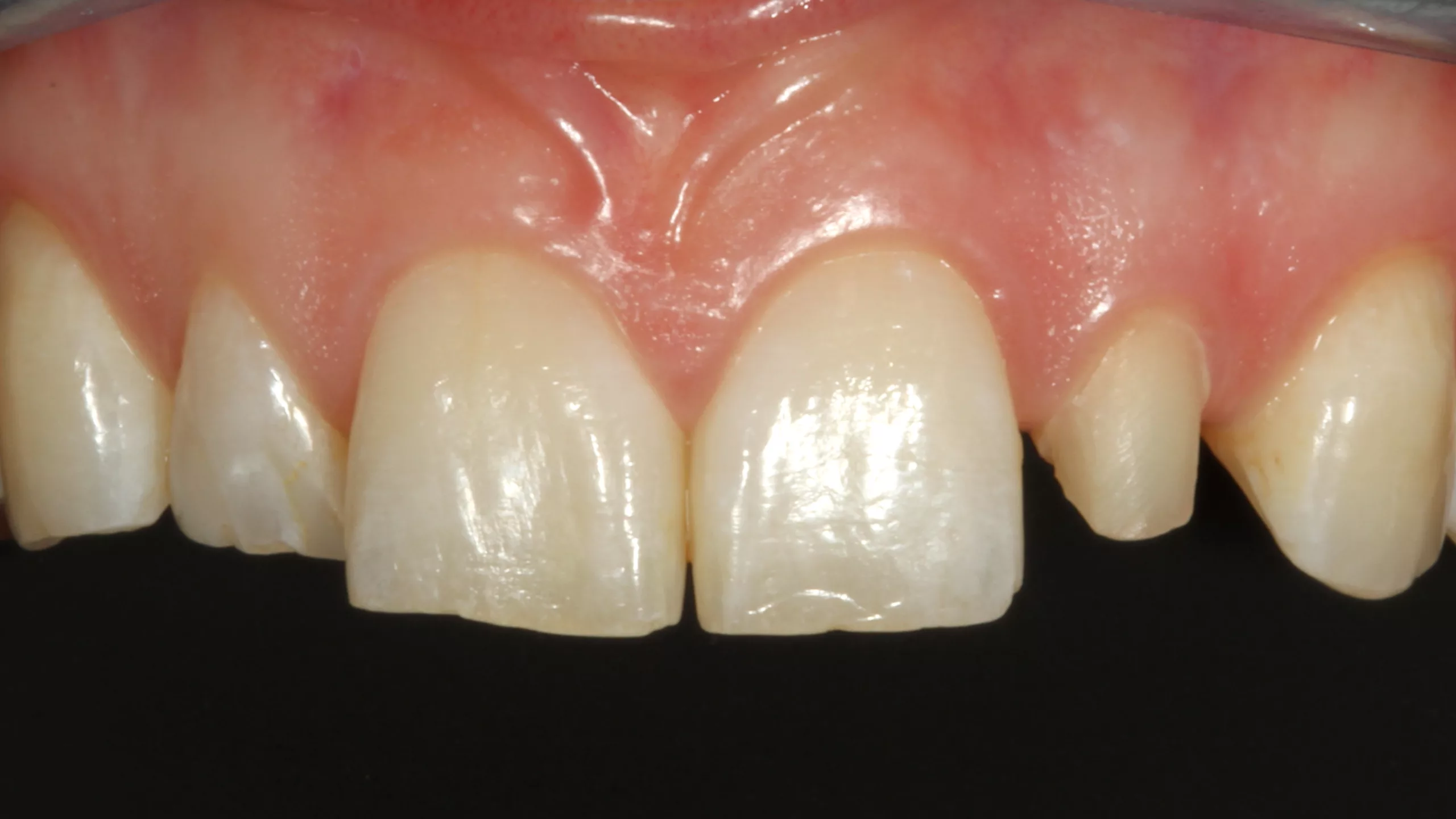 Abb. 10: Vollständig abgebrochener, alio loco erstellter direkter Kompositaufbau an Zahn 22.