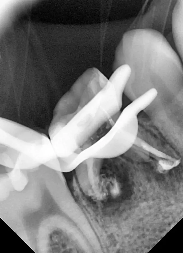 Postoperatives Röntgenbild.