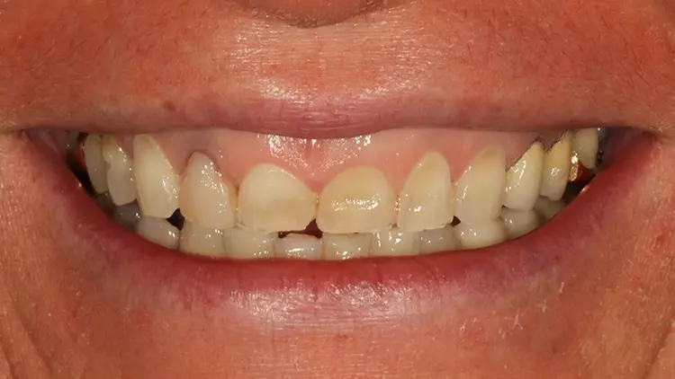 Abb. 31: Lippenbild nach Abschluss der kieferorthopädischen Vorbehandlung
– unmittelbar vor dem Start der restaurativen Therapie.