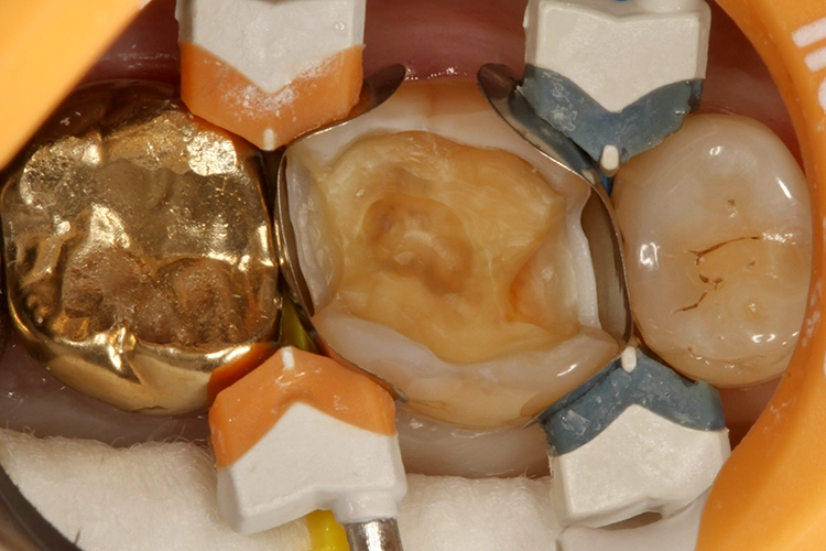 Abb. 33: Die mit 2 Teilmatrizen, 2 Composi-Tight 3D Fusion und 2 Composi-Tight 3D Fusion-Spannringen eingeschalte Kavität.