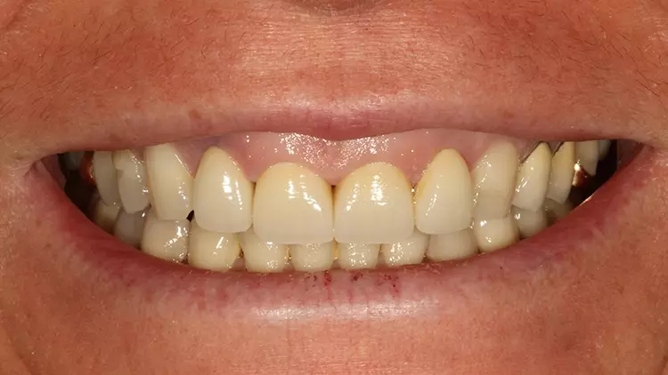 Abb. 35: Lippenbild bei maximalem Hochziehen der Lippe.