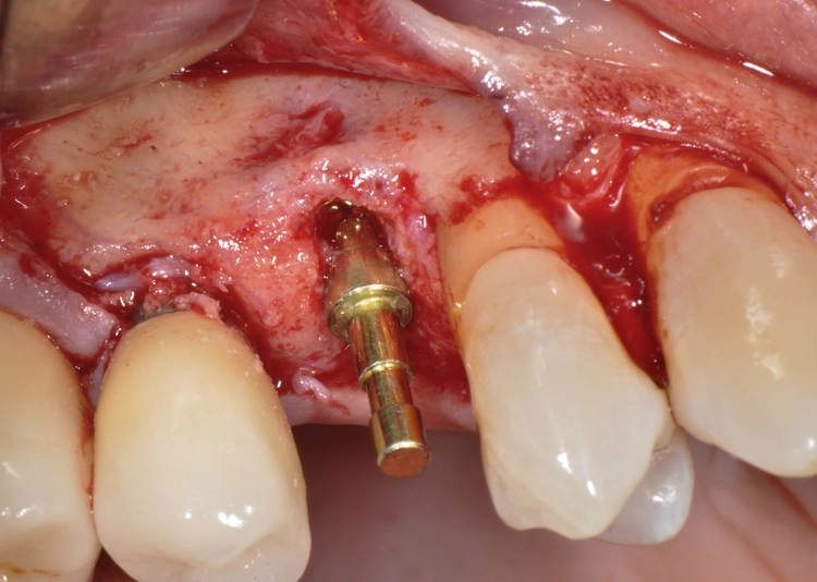 Abb. 8: Richtungsindikator zur Kontrolle der korrekten Implantatpositionierung.