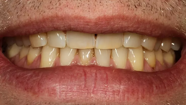 Abb. 37: Lippenbild eines Patienten mit vertikalem Bisshöhenverlust.