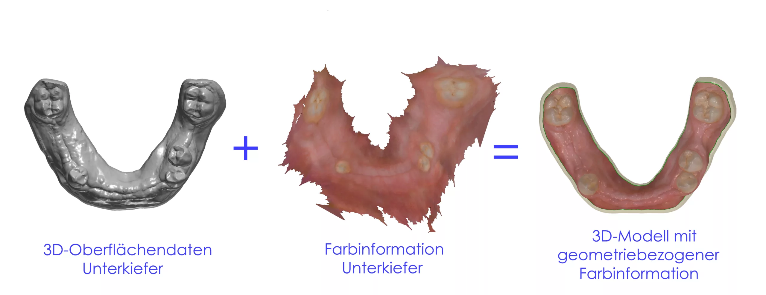Abb. 37: Die Oberflächendaten aus dem intraoralen 3D-Scan eines Kiefers ergeben zusammen mit der Farbinformation das dreidimensionale Modell mit geometriebezogener Farbinformation.
