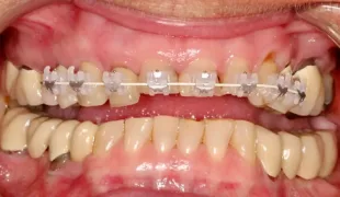 Kieferorthopädische Vorbehandlung über 8 Monate mit einer
OK-Multi-Bracket-Apparatur. Visualisierung bei leicht geöffnetem Mund.