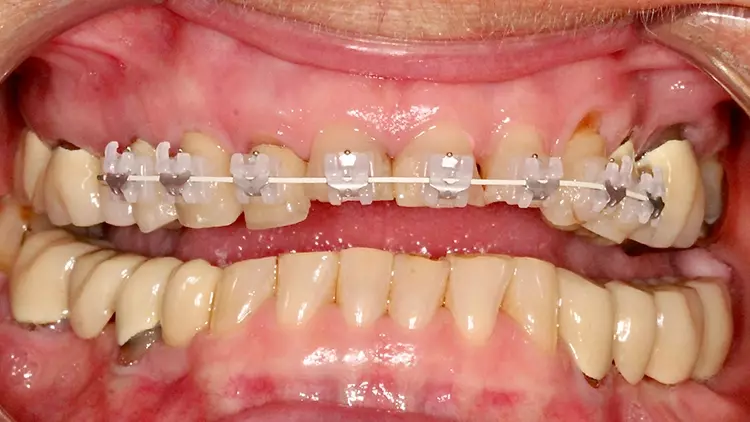 Kieferorthopädische Vorbehandlung über 8 Monate mit einer
OK-Multi-Bracket-Apparatur. Visualisierung bei leicht geöffnetem Mund.