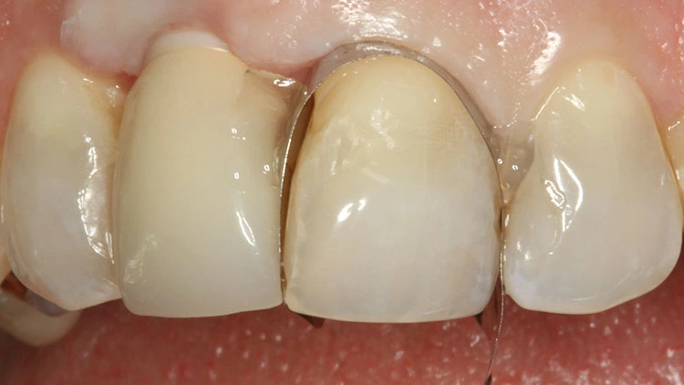Abb. 11: Gingivarezession an Zahn 21 nach implantatprothetischer Versorgung des Zahnes 11 alio loco.