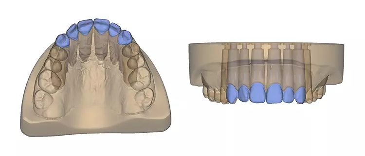Abb. 3: Virtuelle Veneer-Präparation und digitales Modelldesign.