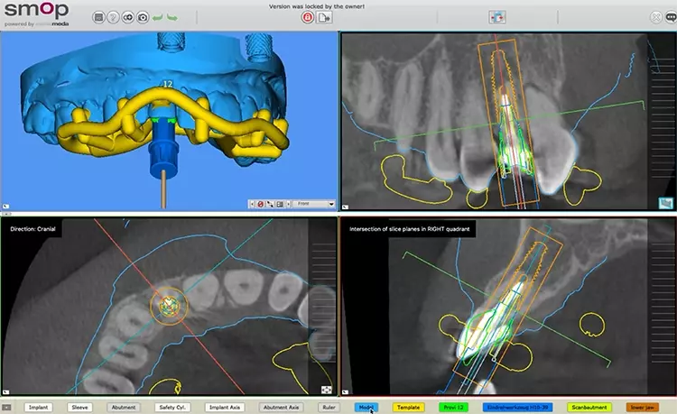 Abb.3: In die SMOP-Implantatplanungssoftware eingespielte STL-Daten des DVTs und des digitalen Abdrucks.